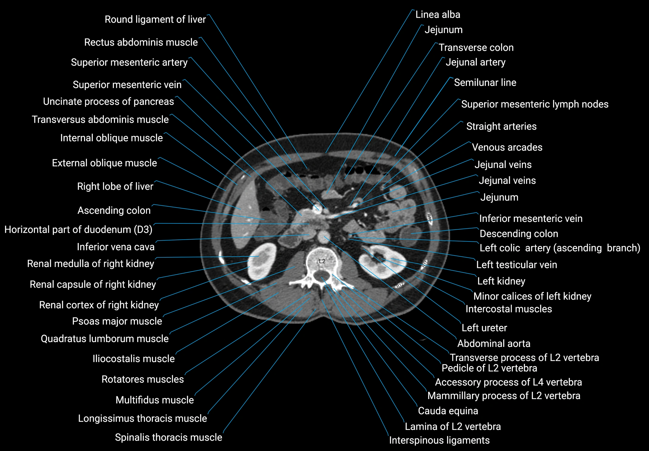 CT male pelvis axial cross sectional anatomy labelled radiology image -00074.webp